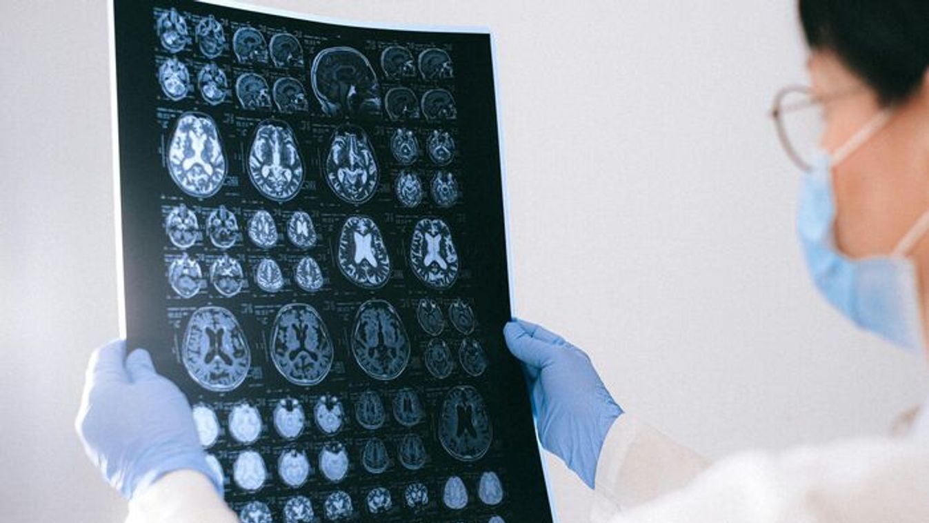 Az emberi agy ismeretlen területei: szegedi kutatók az Alzheimer nyomában