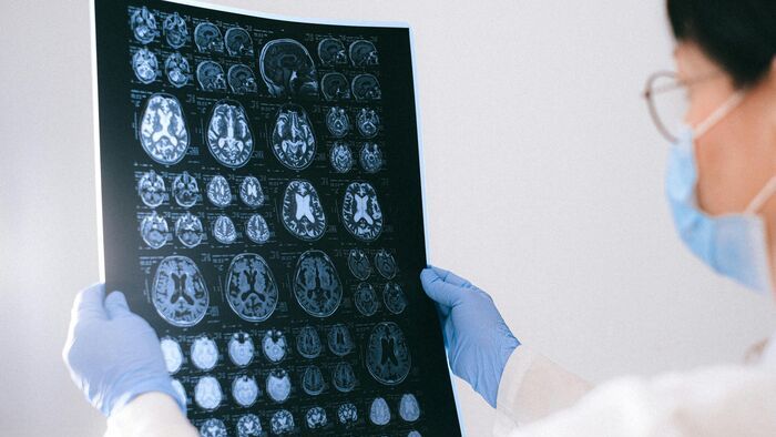 Az emberi agy ismeretlen területei: szegedi kutatók az Alzheimer nyomában