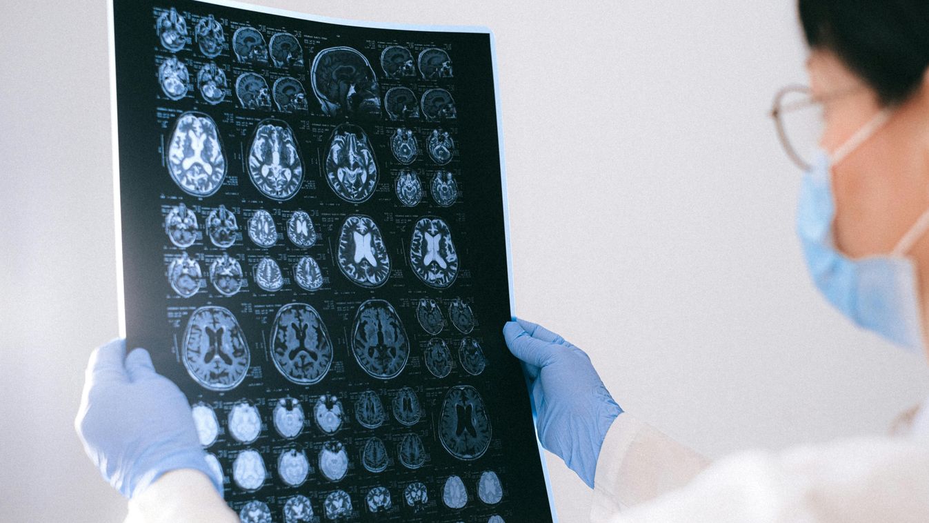 Az emberi agy ismeretlen területei: szegedi kutatók az Alzheimer nyomában
