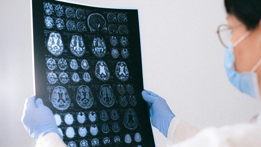 Az emberi agy ismeretlen területei: szegedi kutatók az Alzheimer nyomában